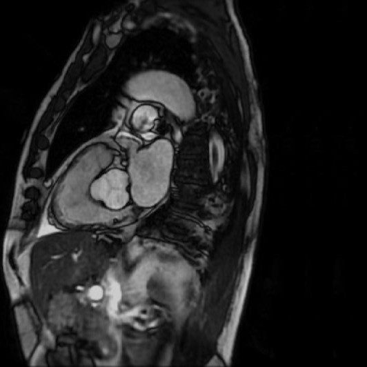 Cardiac MRI scan showing the heart in cross-section