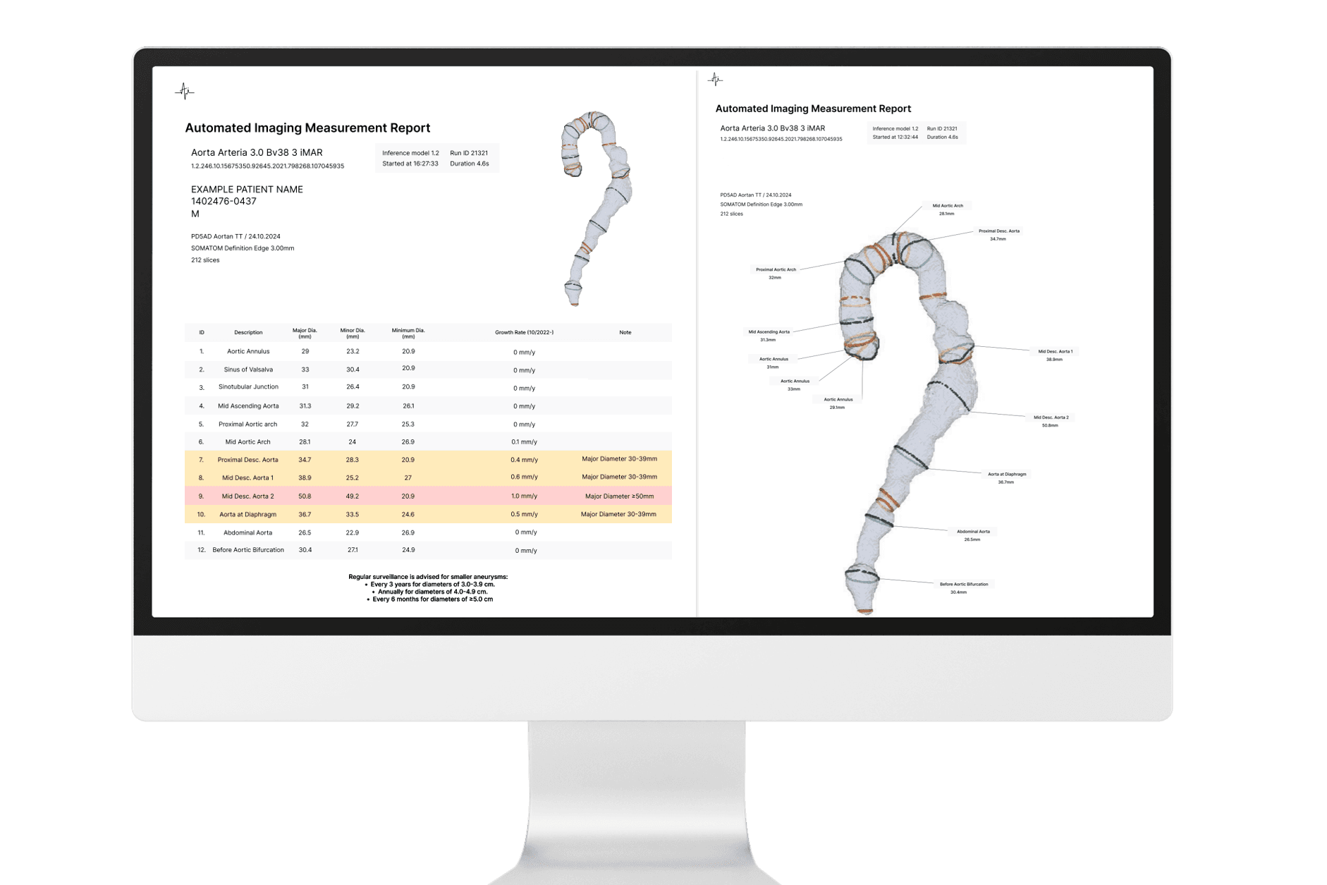 Automated Imaging Measurement report on screen, showing aorta measurements