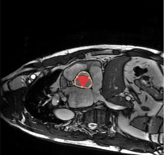 Axial MRI slice with the aorta highlighted in red
